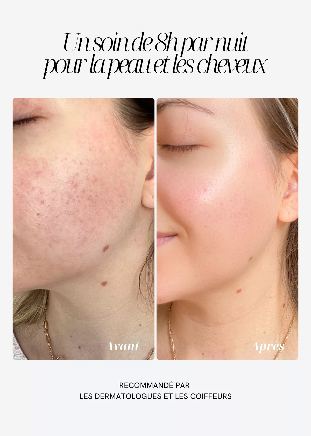 Comparaison avant-après de la peau du visage illustrant les bienfaits beauté de la soie de mûrier et la réduction des frottements nocturnes.